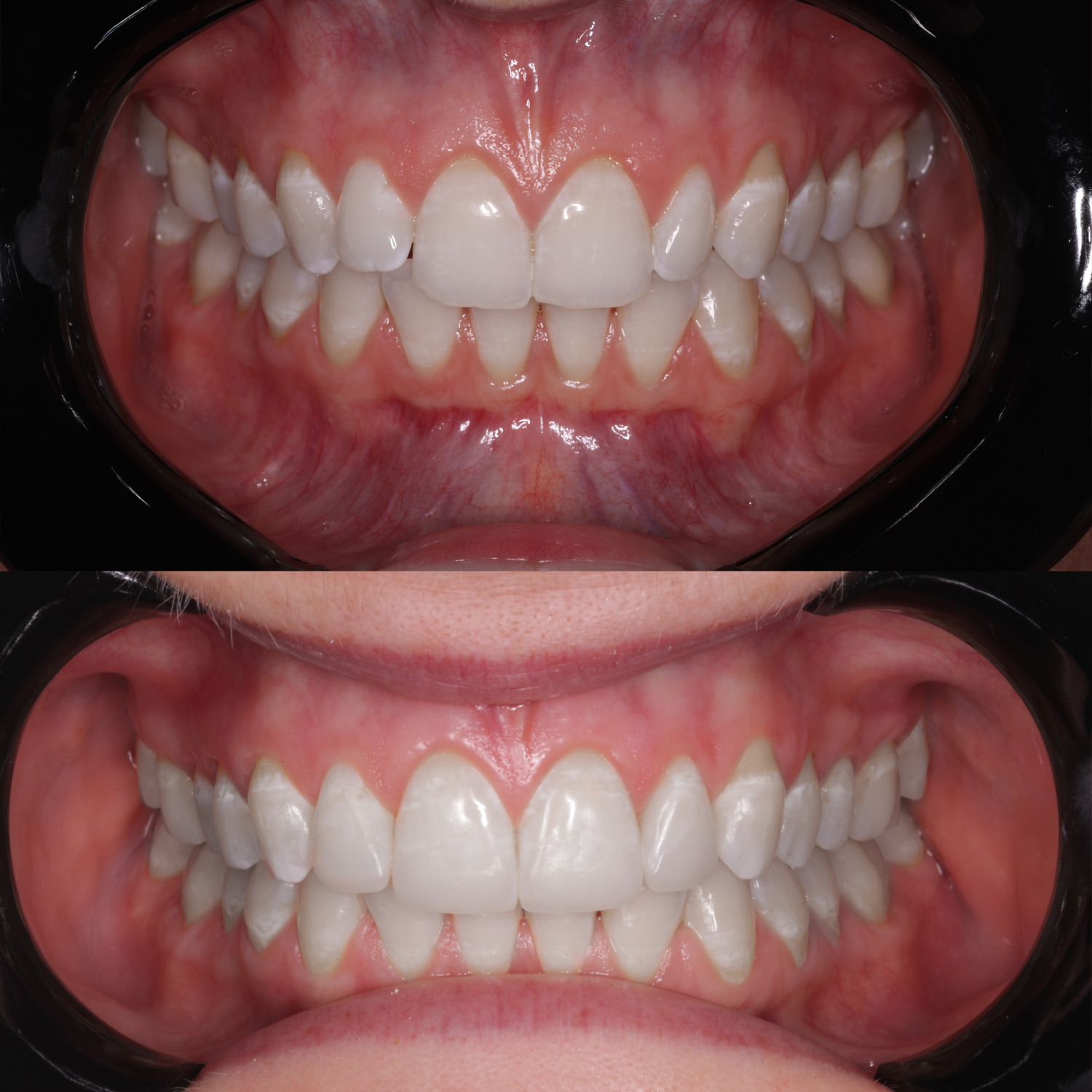 Linea patient, crowding, before and after 7 months of treatment