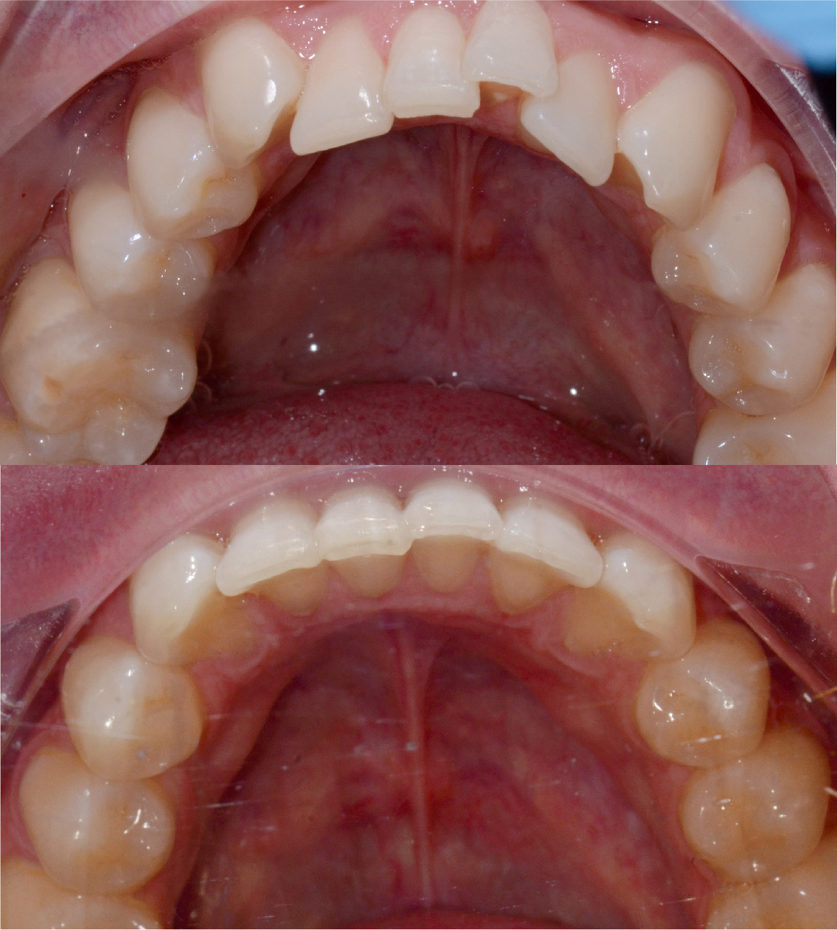 Linea patient, crowding, before and after 6 months of treatment